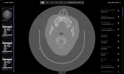 The MONAI Deploy study viewer: an anonymised head CT beside its series thumbnails and DICOM metadata